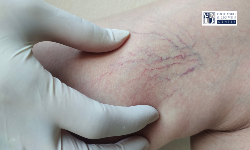 Varicose Vein Treatment and Why Symptoms Often Progress Over Time