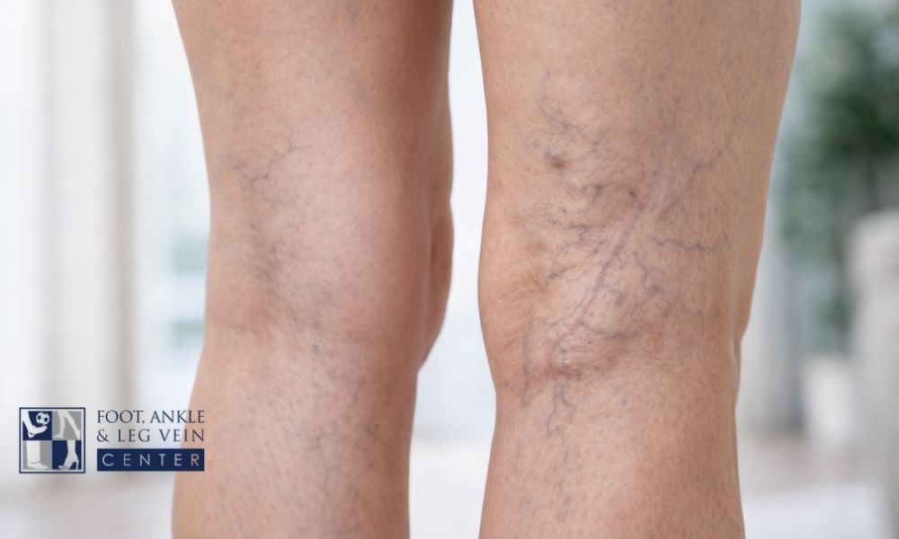 What Happens If You Leave Varicose Veins Untreated for Years?